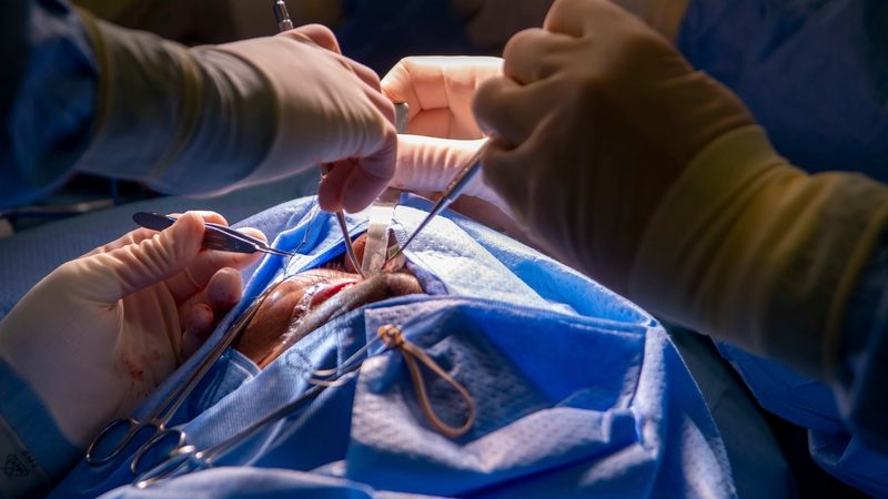 Gastric Sleeve vs Gastric Bypass: How Surgeons Choose