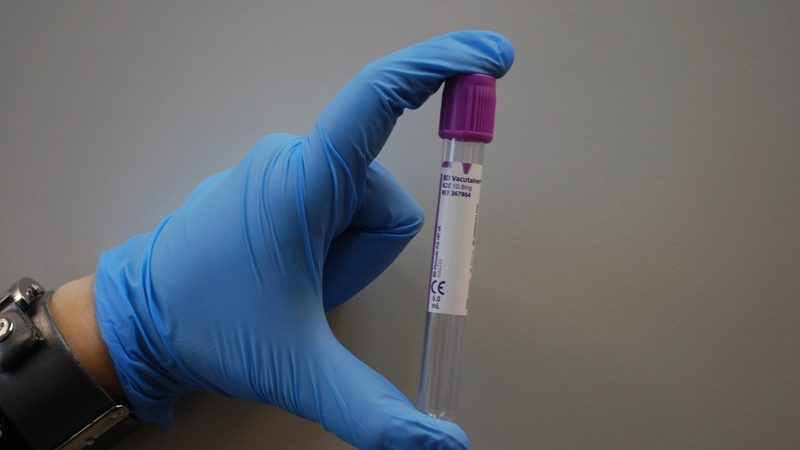 PSA Test Explained: What a High Number Really Means