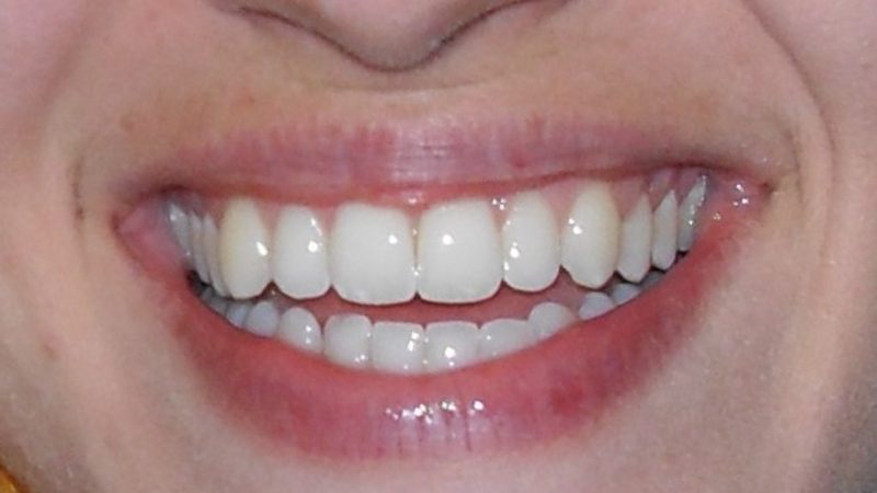 Veneers oder Kronen: Der Unterschied und warum er zählt